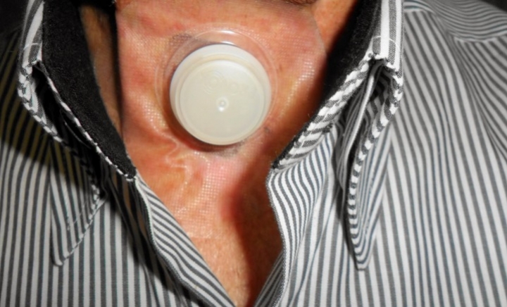 Dia Nacional do Laringectomizado: ACBG Brasil defende estrutura e atendimento adequados aos&nbsp;pacientes