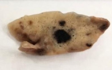 Estudo descreve dois diferentes padrões de dano no pulmão de vítimas da&nbsp;COVID-19