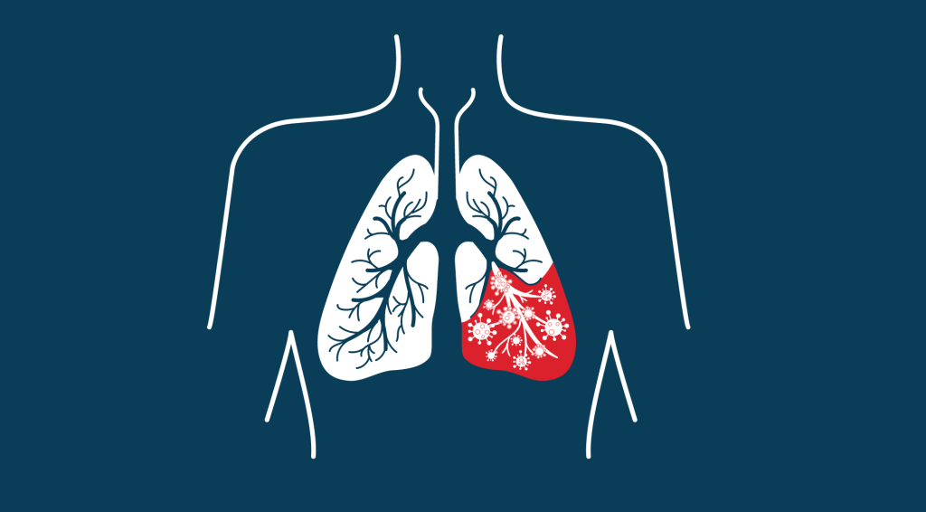 Você sabe que existem vários tipos de&nbsp;pneumonia?
