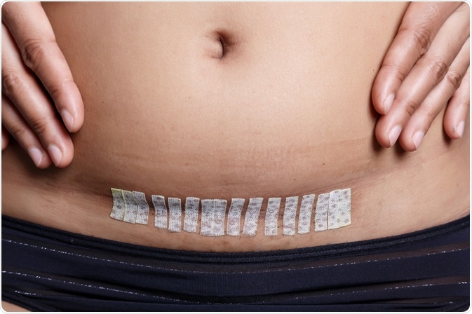 Histerectomia: quando a retirada do útero é&nbsp;necessária