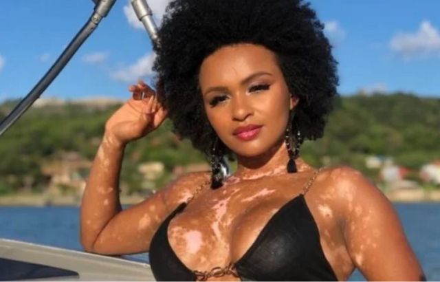 Autoimune ao preconceito: Saiba mais sobre o vitiligo, condição que afeta cerca de um milhão de pessoas em todo o&nbsp;Brasil