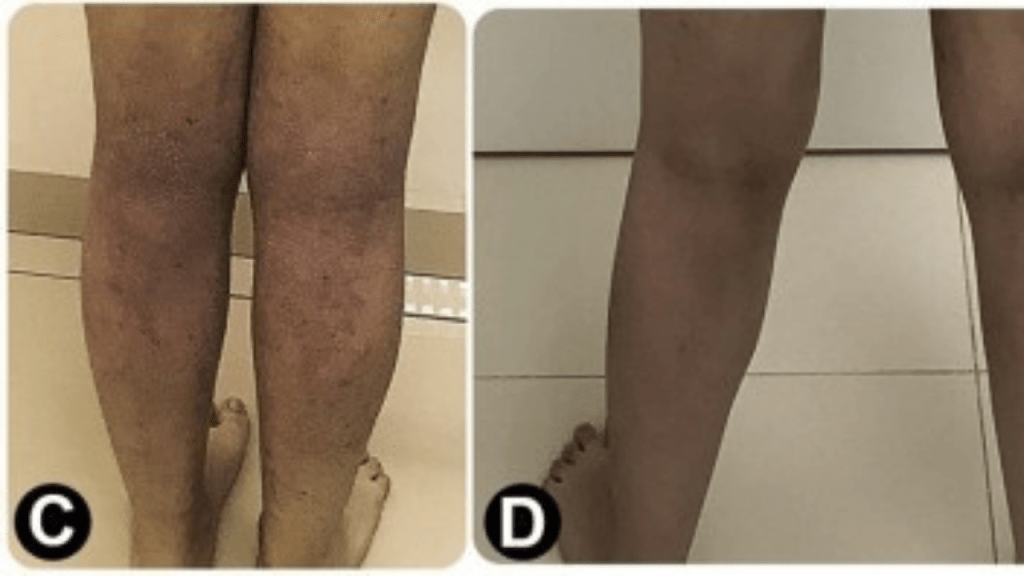 Imunoterapia com extrato de ácaro doméstico reduz sintomas da dermatite&nbsp;atópica