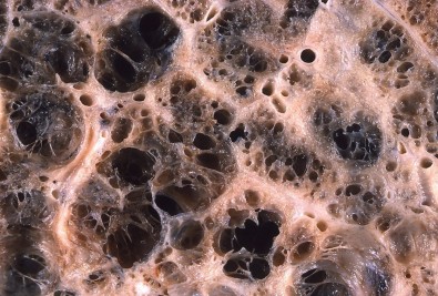 Doença pulmonar obstrutiva crônica causa o envelhecimento precoce do sistema imune, sugere estudo