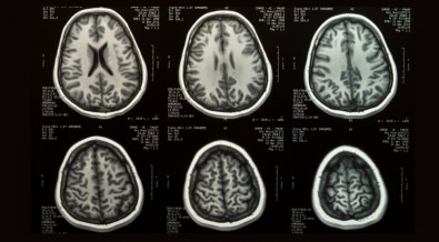 Cientistas criam ferramenta de referência para o desenvolvimento cerebral com o maior banco de dados de pacientes já&nbsp;reunido