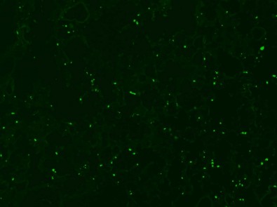 Estudo desvenda mecanismo que leva à síndrome respiratória aguda grave associada à&nbsp;malária