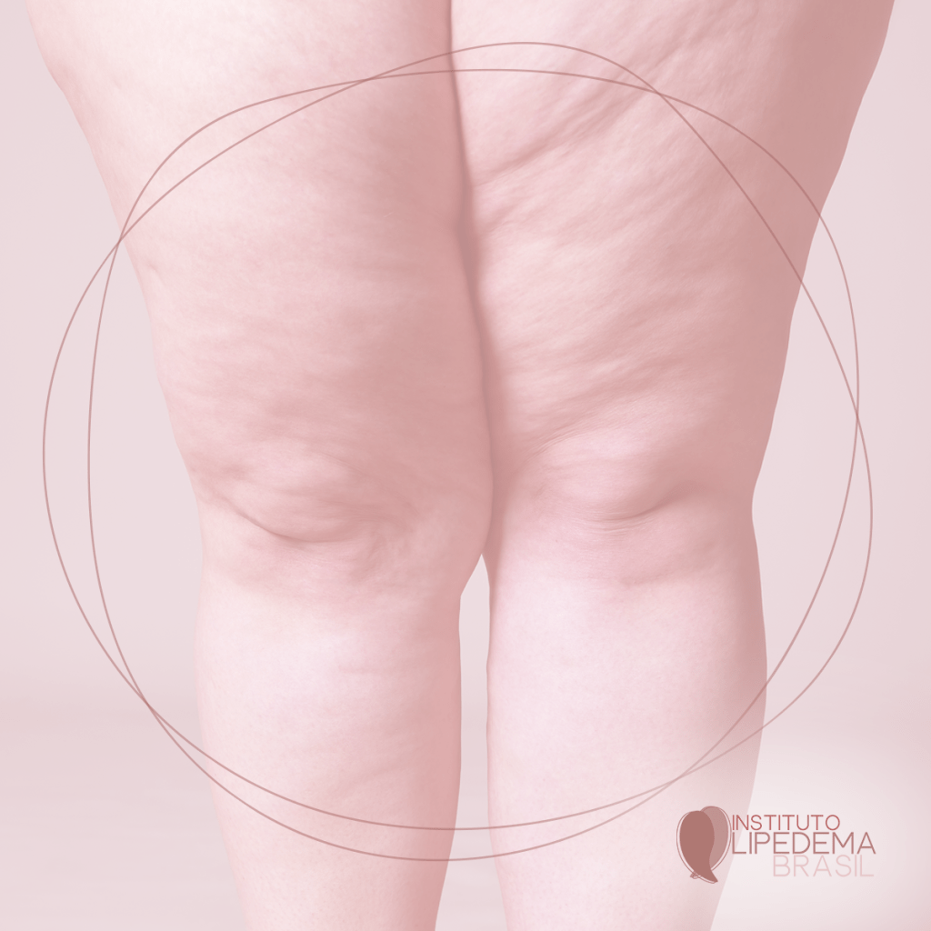 No Mês de Conscientização Mundial do Lipedema, especialista fala sobre a doença que atinge milhões de brasileiras 