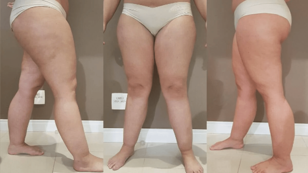 Lipedema x Saúde Mental: Como a doença pode desencadear distúrbios psicológicos em mulheres como depressão e redução de&nbsp;autoestima