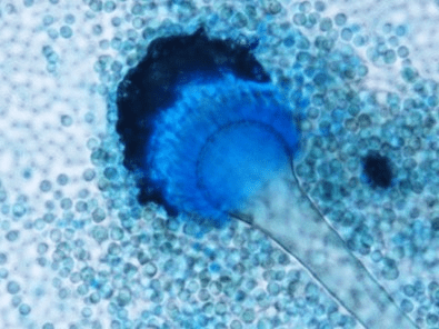 No mundo todo, infecções fúngicas aumentaram a mortalidade de internados por&nbsp;COVID-19