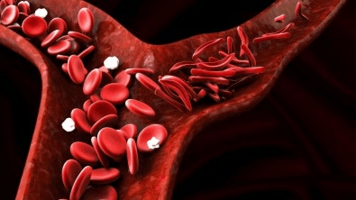 Sistema imune de pacientes com anemia falciforme melhora após transplante de células-tronco da&nbsp;medula