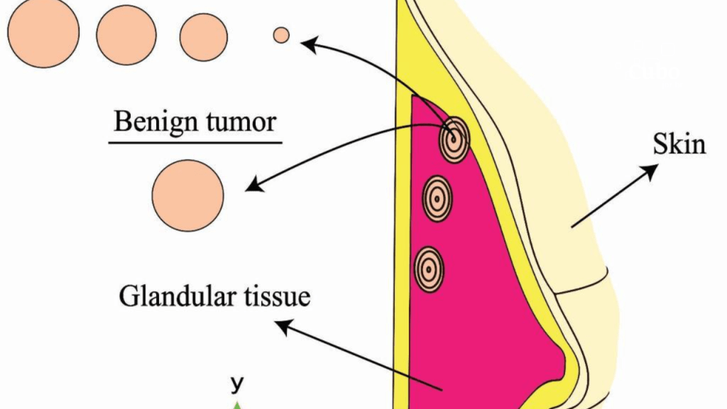 Pesquisadores da UFMA publicam artigo sobre rastreamento de câncer de mama em revista internacional de&nbsp;excelência