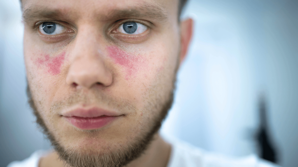 Lúpus: compreendendo e gerenciando uma doença autoimune&nbsp;crônica