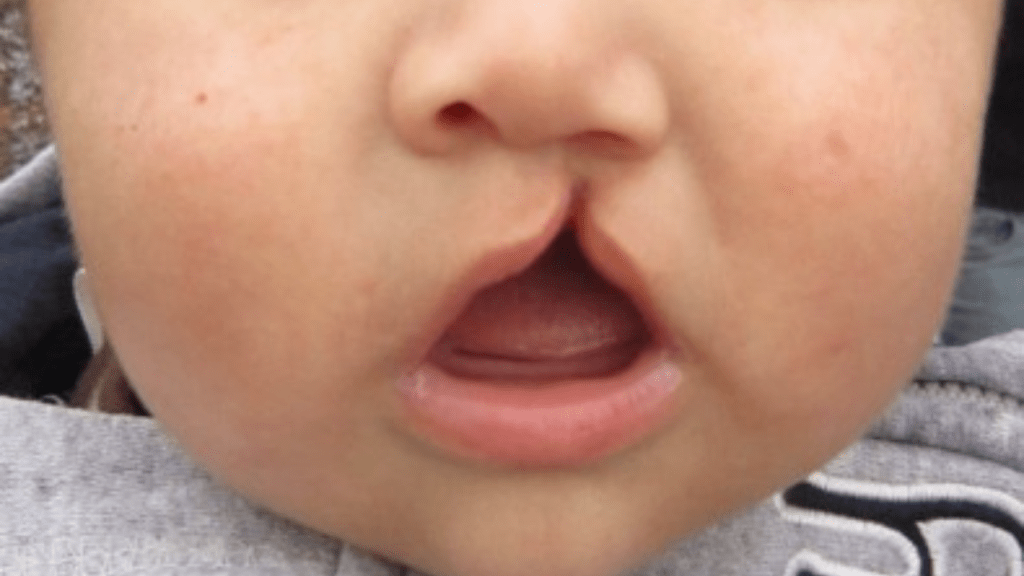 Inflamação na gravidez pode causar lábio leporino em indivíduos com predisposição&nbsp;genética