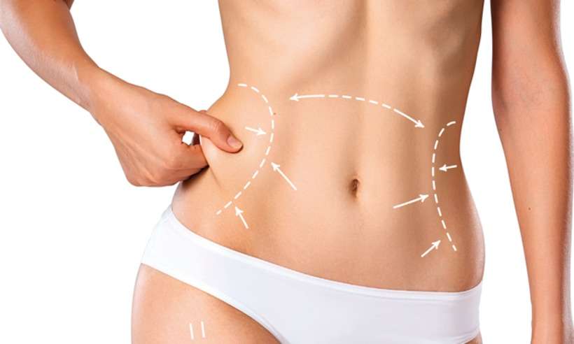 Especialista tira as principais dúvidas sobre&nbsp;abdominoplastia