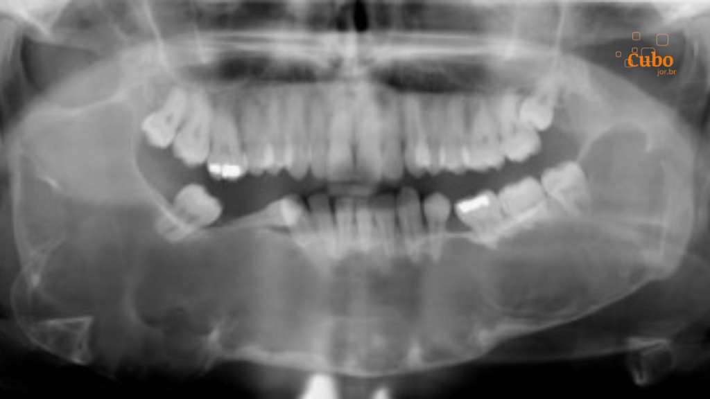 Nova técnica permite diferenciar lesões orais pela análise de textura de&nbsp;imagem
