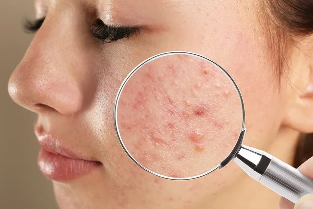 A Acne pode matar? Descubra se isso é verdade e veja os melhores cuidados e prevenções para tratar o&nbsp;problema