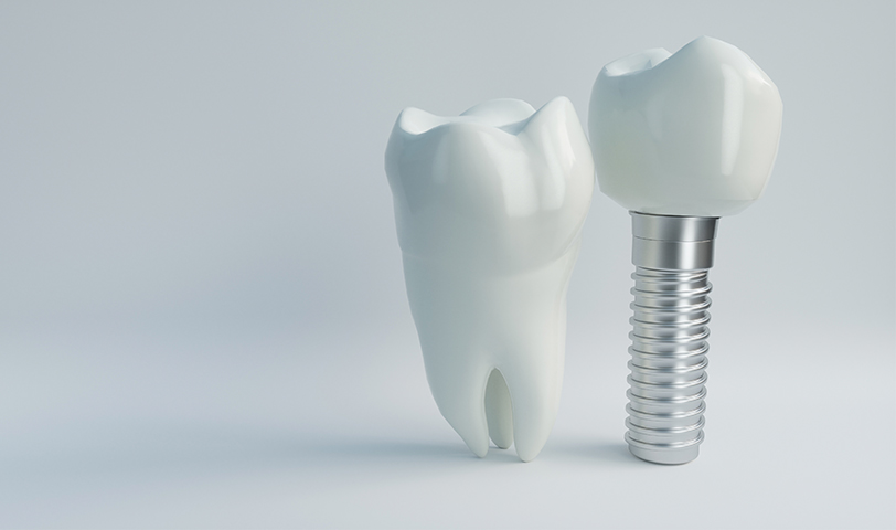 Conheça as técnicas mais utilizadas em implantes&nbsp;dentários