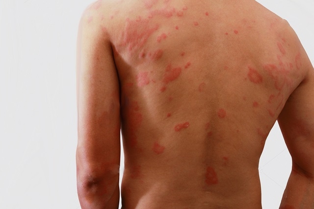 Hanseníase: Como é feito o&nbsp;Diagnóstico?