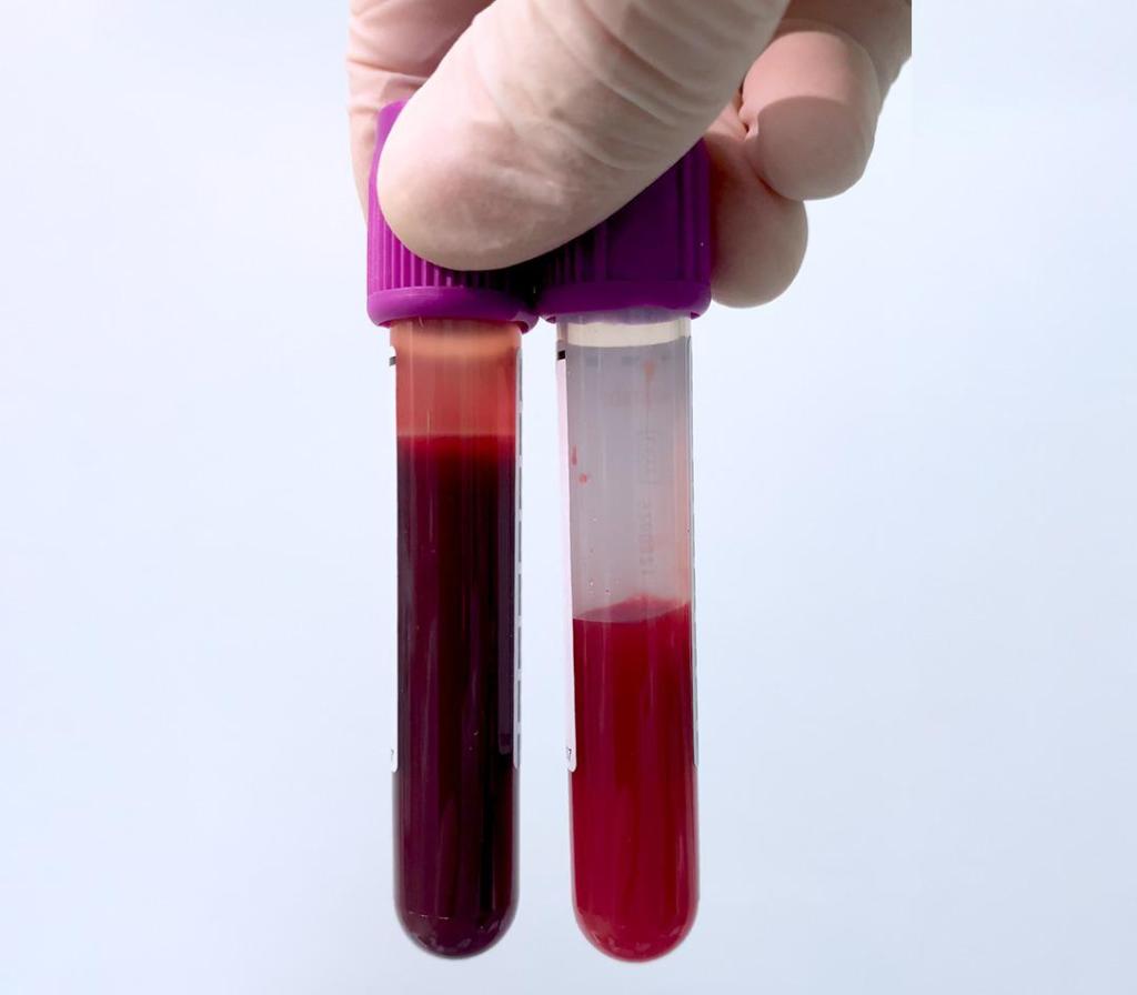 Falta de energia e cansaço podem ser sinais de anemia, diz&nbsp;especialista