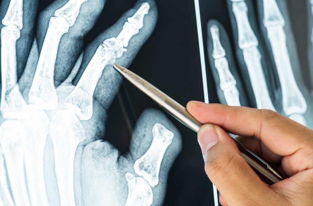 Saúde: Quando uma fratura requer&nbsp;cirurgia?