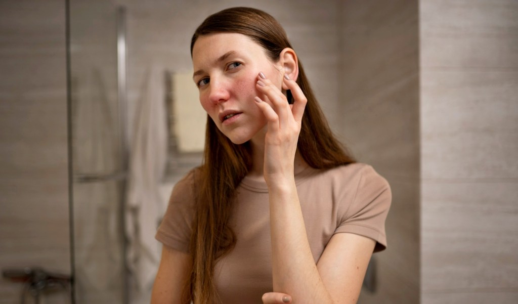 O grande vilão dos jovens: espinhas podem ser tratadas e prevenidas, afirma&nbsp;especialista