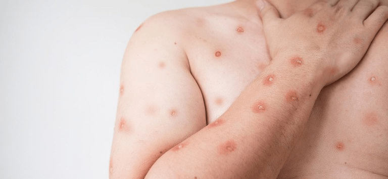 Entenda o que é o Mpox, quais as etapas da doença, qual a sua gravidade, sintomas e&nbsp;prevenção