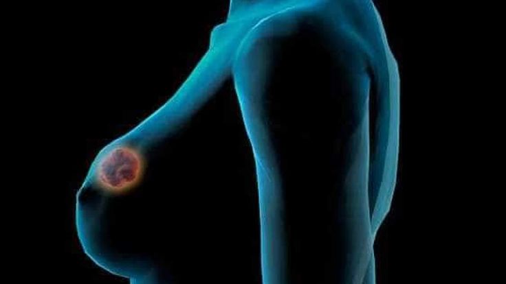 Câncer de mama: o que são os testes genéticos, quem tem direito e onde podem ser feitos&nbsp;gratuitamente