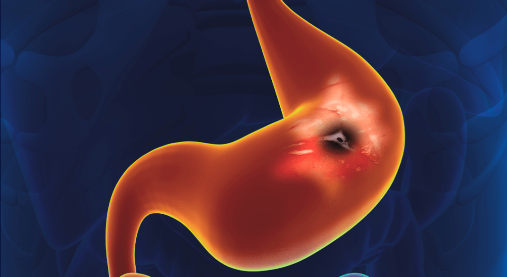 Por que falamos tão pouco sobre o câncer&nbsp;gástrico?