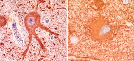 Pesquisadores brasileiros criam atlas celular para malformação do cérebro associada à epilepsia&nbsp;grave