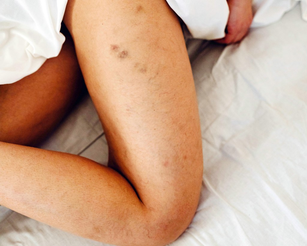 Sinais na pele podem indicar problemas vasculares e outras doenças&nbsp;graves