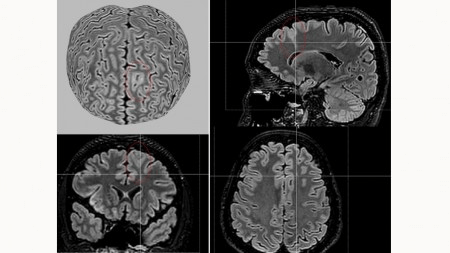 Ferramenta de IA detecta anormalidades cerebrais invisíveis em pessoas com epilepsia&nbsp;grave