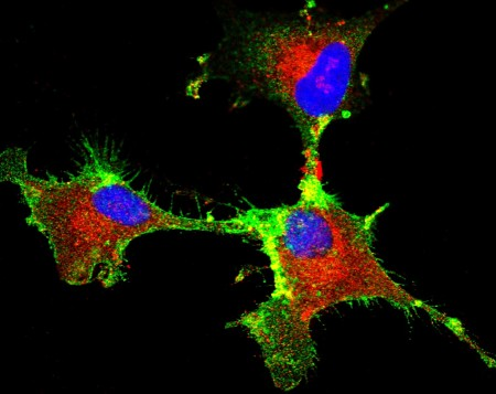 Estudo revela proteína-chave para a progressão do glioblastoma, um tipo de tumor&nbsp;cerebral