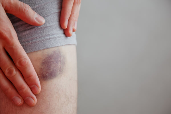 Apareceu um roxo e você não faz ideia de onde veio? Entenda como os hematomas se formam